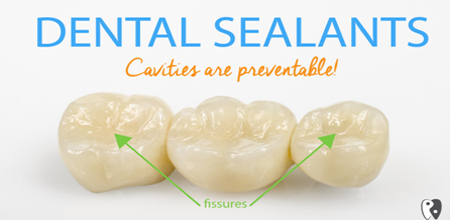 32 Smile Stone Dental Sealants