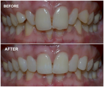 cosmetic smile designing Before & After
