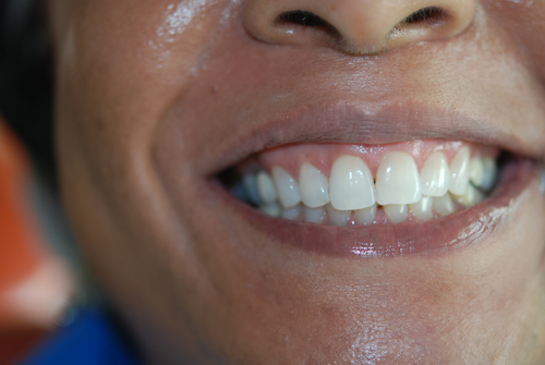 32 Smile Stone Zoom Teeth Whitening after1