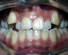 32 Smile Stone Braces used to correct crowded teeth