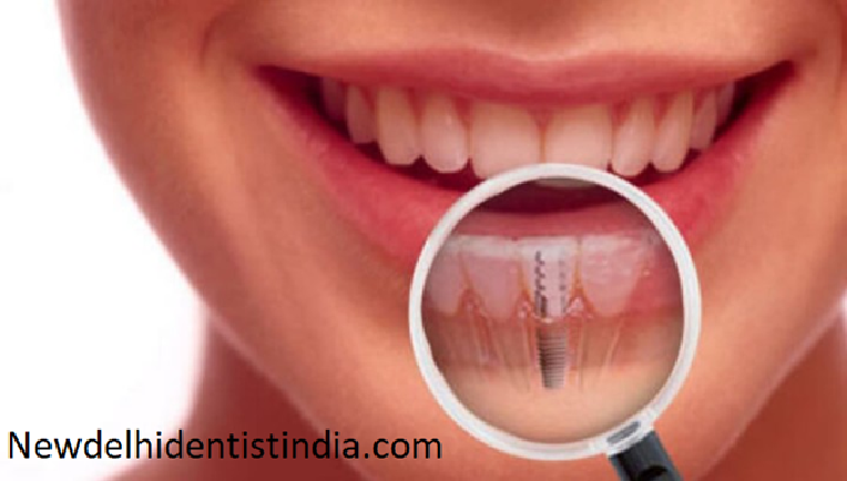 dental implant delhi blog
