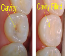 early stage cavity