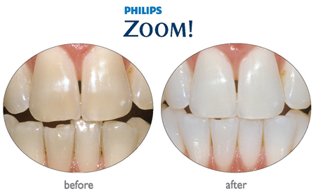 32 Smile Stone Teeth Whitening System
