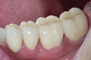 Porcelain Crowns