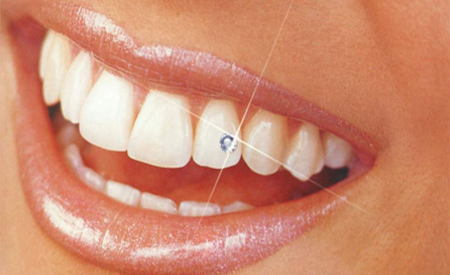 Dental Jewellery in new delhi