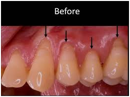 Cosmetic Gum Treatment in new delhi