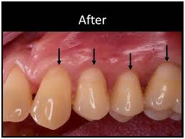 32 Smile Stone After Cosmetic Gum Treatment