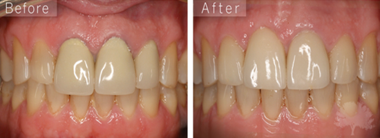 Dental Crown Before & After