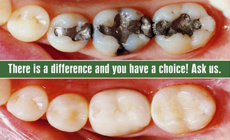 Dental Filling Cost Composite Dental Fillings Delhi