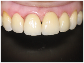 Ceramic Veneers bonded to the teeth