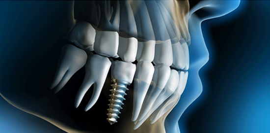32 Smile Stone Dental Implants