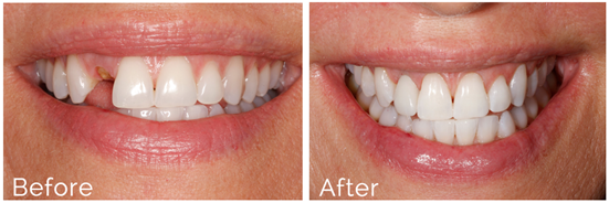 Dental Implants Before & After