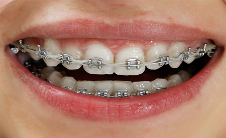 32 Smile Stone Metal Braces