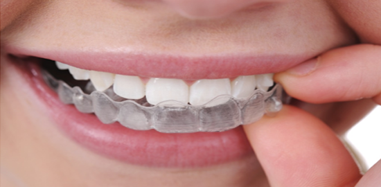 Invisible Teeth Braces In Delhi Cost Of Teeth Aligners In India