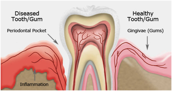 Dental Filling Cost Composite Dental Fillings Delhi