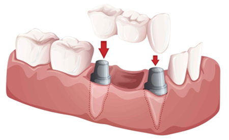 Dental Bridge treatment in new delhi