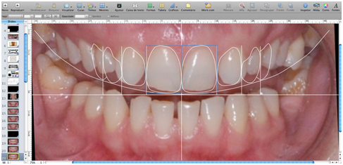 steps involved in smile designing