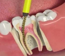 Root Canal Treatment blog