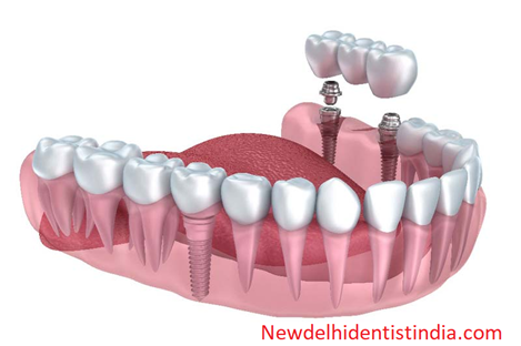 dental implants delhi india